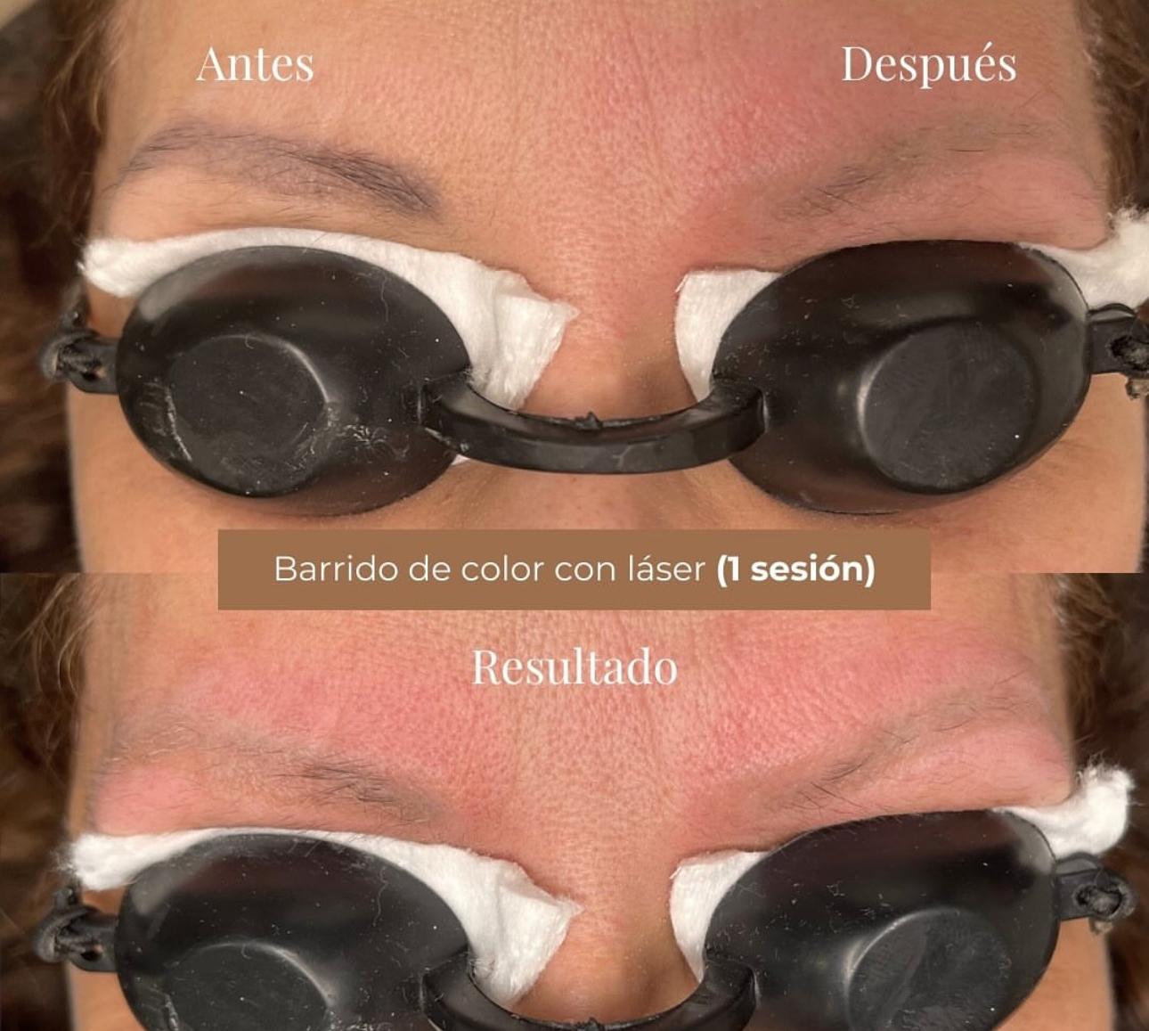 Eliminacion microblading Madrid
